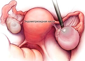 Лечение эндометриоидной кисты яичника