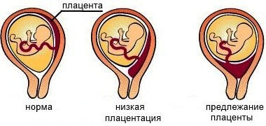 Расположение плаценты при беременности