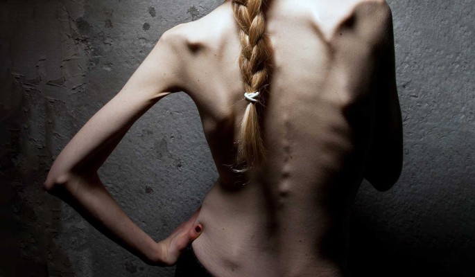 "До состояния анорексички": От разбитой онкологией Заворотнюк остались кожа да кости