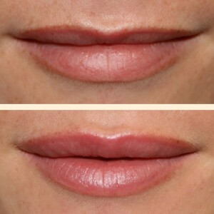 Пластика губ