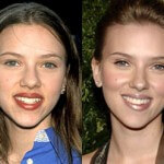 Ринопластика