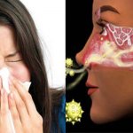 Признаки аллергического ринита