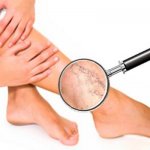 Варикоз: как не допустить и как лечить