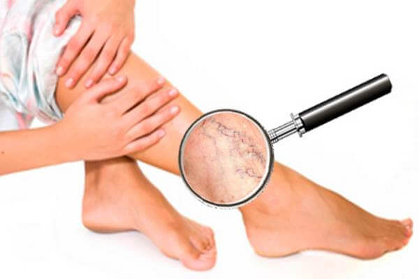 Варикоз: как не допустить и как лечить