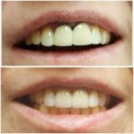 Плюсы металлокерамических коронок