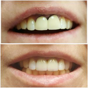 Плюсы металлокерамических коронок