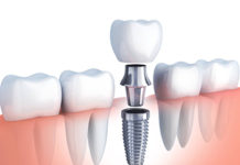 Показания к имплантации зубов