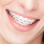 Почему стоит обратить внимание на сапфировые брекеты?