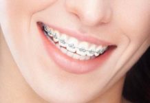 Почему стоит обратить внимание на сапфировые брекеты?