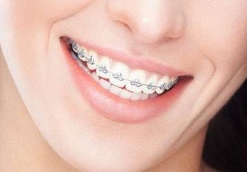 Почему стоит обратить внимание на сапфировые брекеты?