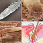 Демодекоз — как проявляется и диагностируется