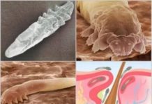 Демодекоз — как проявляется и диагностируется