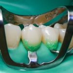 Технологии лечения кариеса зубов