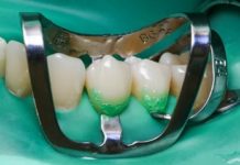 Технологии лечения кариеса зубов