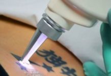 Принцип удаления татуировок лазером