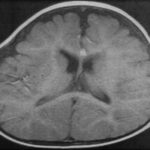 Лечение наружной гидроцефалии головного мозга