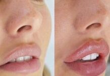 Увеличение губ: способы современной косметологии