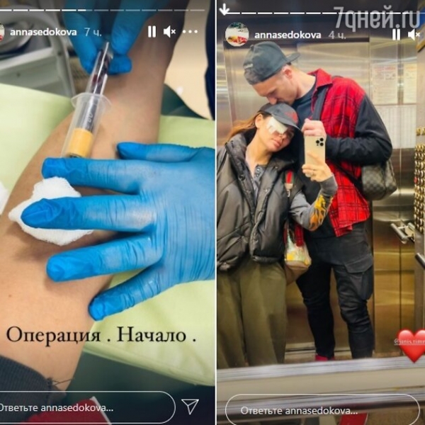 «Решила резать»: Анна Седокова перенесла операцию