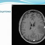 Лечение астроцитомы
