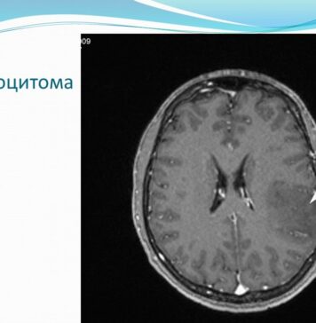 Лечение астроцитомы