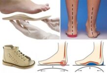 Как правильно выбрать правильную ортопедическую обувь?