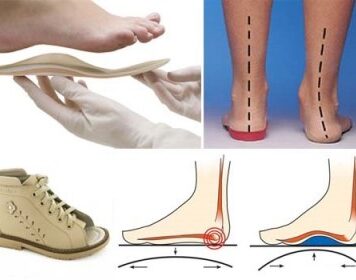 Как правильно выбрать правильную ортопедическую обувь?
