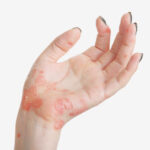 Экзема и дерматит. Чем отличаются эти заболевания?