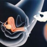 Искусственная инсеминация: показания, техника проведения, эффективность метода