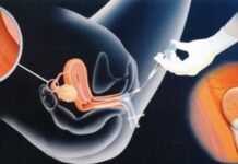 Искусственная инсеминация: показания, техника проведения, эффективность метода