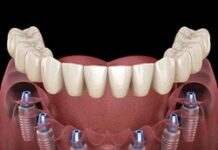 Имплантация: надежный и универсальный способ восстановления потерянных зубов
