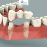 Виды несъемных протезов