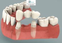 Виды несъемных протезов