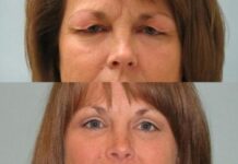 Пластика нижних век: как проходит операция?