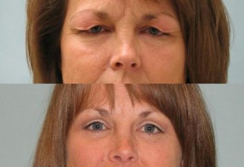 Пластика нижних век: как проходит операция?