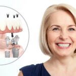 Имплантация All-on-4: особенности технологии