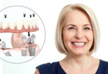 Имплантация All-on-4: особенности технологии