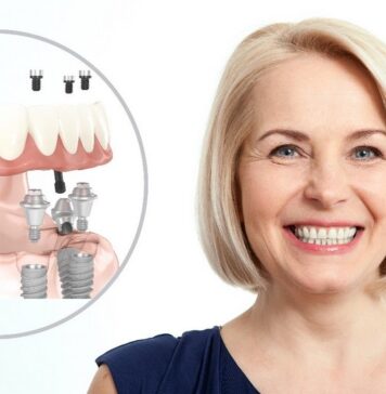 Имплантация All-on-4: особенности технологии