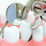 Современные методы удаления зубов