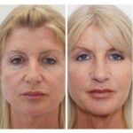 Биоревитализация: преимущества процедуры, эффект