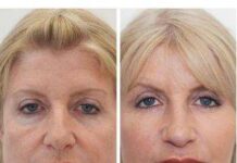 Биоревитализация: преимущества процедуры, эффект