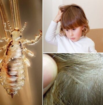 Почему возникает педикулез у детей