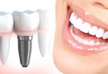 Имплантация зубов: современный метод восстановления утраченных зубов