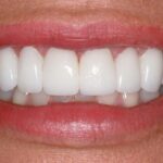 Имплантация передних зубов: особенности операции