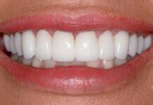 Имплантация передних зубов: особенности операции