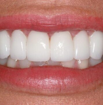 Имплантация передних зубов: особенности операции