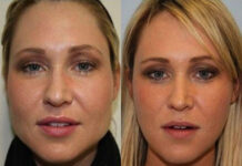 Липосакция щек: особенности проведения