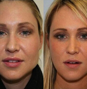 Липосакция щек: особенности проведения