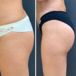Виды липосакции ягодиц