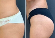 Виды липосакции ягодиц