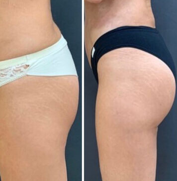 Виды липосакции ягодиц